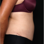 Tummy Tuck Before & After Patient #32234