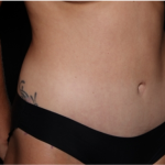 Tummy Tuck Before & After Patient #32243