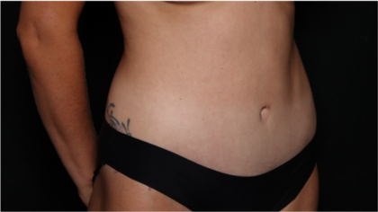 Tummy Tuck Before & After Patient #32243