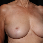 Breast Reduction Before & After Patient #32264