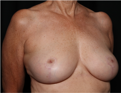 Breast Reduction Before & After Patient #32264