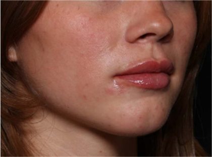 Lip Filler Before & After Patient #32312