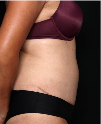 Tummy Tuck Before & After Patient #32234