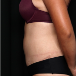 Tummy Tuck Before & After Patient #32234