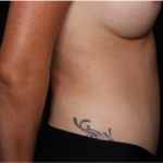 Tummy Tuck Before & After Patient #32243