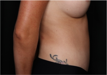 Tummy Tuck Before & After Patient #32243