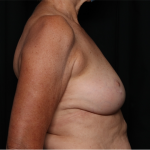 Breast Reduction Before & After Patient #32264