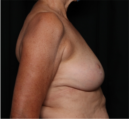 Breast Reduction Before & After Patient #32264