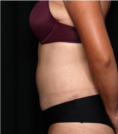 Tummy Tuck Before & After Patient #32234