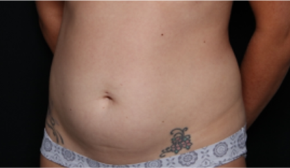 Tummy Tuck Before & After Patient #32243