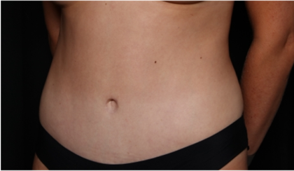 Tummy Tuck Before & After Patient #32243