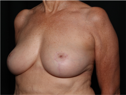 Breast Reduction Before & After Patient #32264