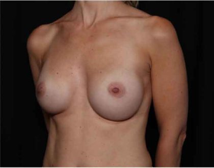 Breast Augmentation - Round Silicone Implants Before & After Patient #32319