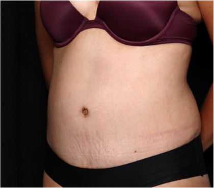 Tummy Tuck Before & After Patient #32234