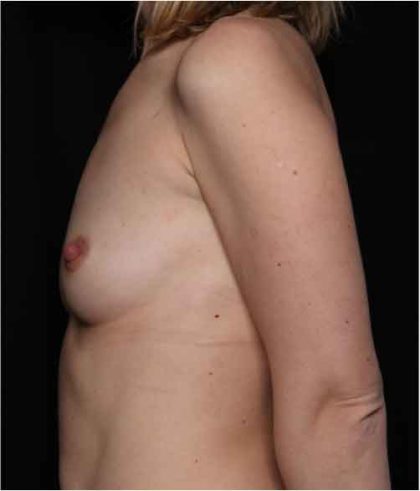 Breast Augmentation - Round Silicone Implants Before & After Patient #32319