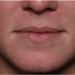 Lip Filler Before & After Patient #32296