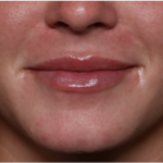 Lip Filler Before & After Patient #32296