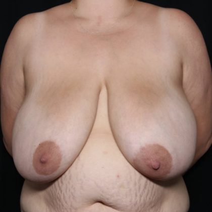 Breast Reduction Before & After Patient #32344