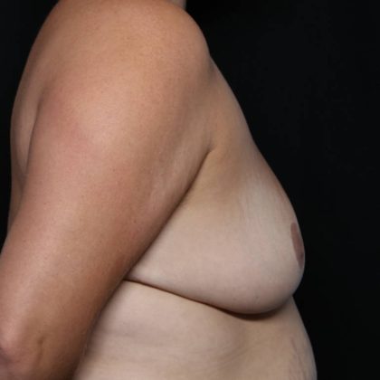 Breast Reduction Before & After Patient #32344