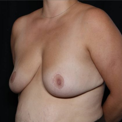 Breast Reduction Before & After Patient #32344