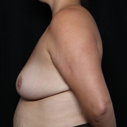 Breast Reduction Before & After Patient #32344