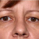 Blepharoplasty and Brow Lift Before & After Patient #32398