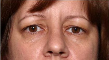 Blepharoplasty and Brow Lift Before & After Patient #32398