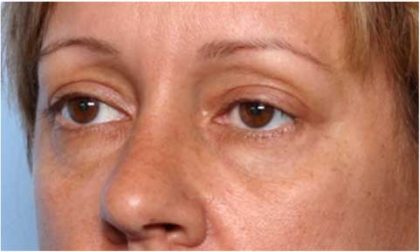 Blepharoplasty and Brow Lift Before & After Patient #32398