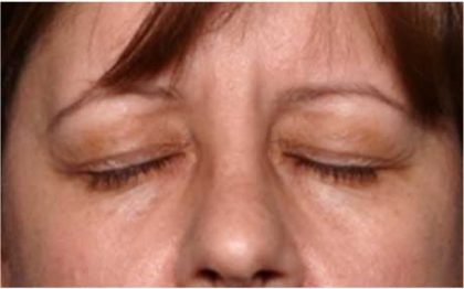 Blepharoplasty and Brow Lift Before & After Patient #32398