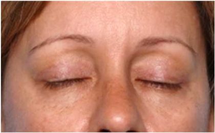 Blepharoplasty and Brow Lift Before & After Patient #32398