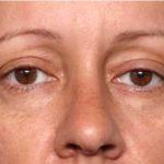 Blepharoplasty and Brow Lift Before & After Patient #32398