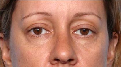 Blepharoplasty and Brow Lift Before & After Patient #32398