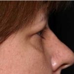 Blepharoplasty and Brow Lift Before & After Patient #32398