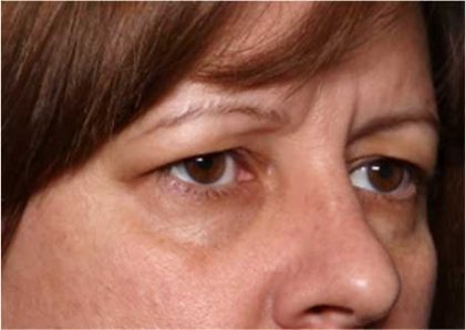 Blepharoplasty and Brow Lift Before & After Patient #32398