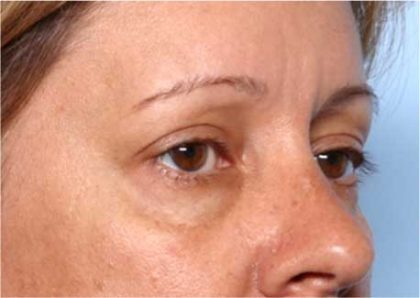 Blepharoplasty and Brow Lift Before & After Patient #32398