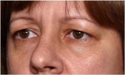 Blepharoplasty and Brow Lift Before & After Patient #32398