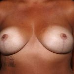 Breast Lift Before & After Patient #32465