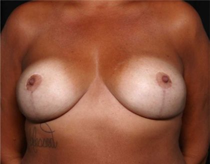 Breast Lift Before & After Patient #32465