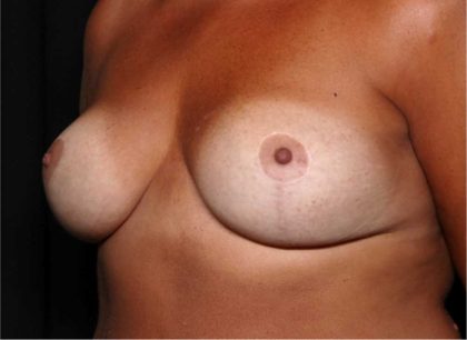 Breast Lift Before & After Patient #32465