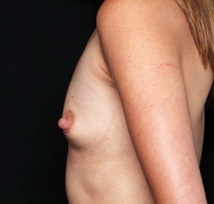 Breast Augmentation Before & After Patient #32365