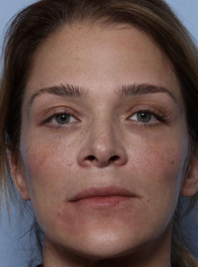 Sculptra Before & After Patient #32379