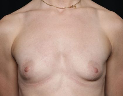 Breast Augmentation Before & After Patient #32386