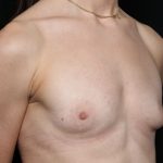 Breast Augmentation Before & After Patient #32386