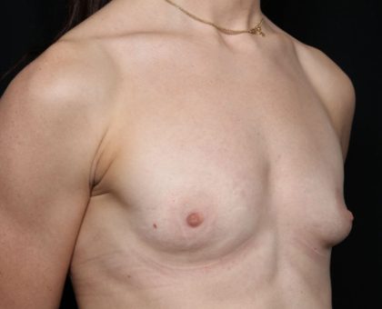 Breast Augmentation Before & After Patient #32386