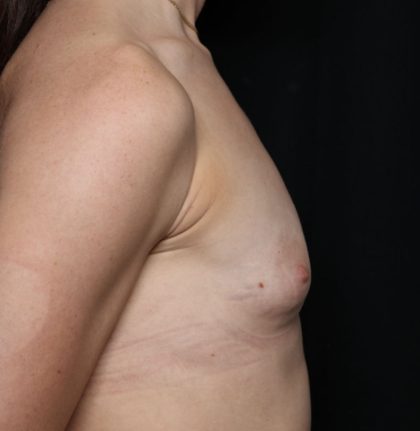 Breast Augmentation Before & After Patient #32386