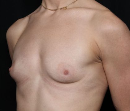 Breast Augmentation Before & After Patient #32386