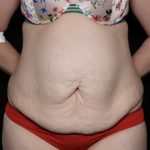 Tummy Tuck Before & After Patient #32411