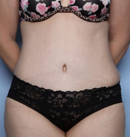 Tummy Tuck Before & After Patient #32411