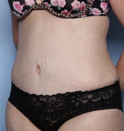 Tummy Tuck Before & After Patient #32411