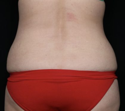 Tummy Tuck Before & After Patient #32411